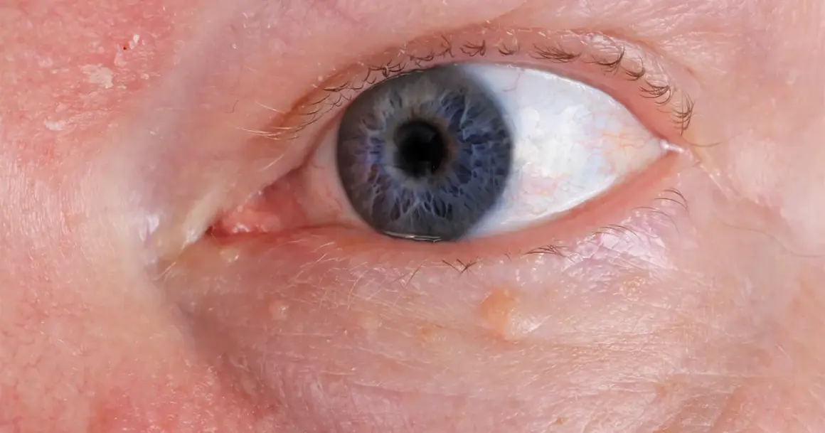 Nahaufnahme eines blauen Auges mit kleinen Bläschen am Lidrand, die auf **Herpes am Auge** hindeuten könnten.