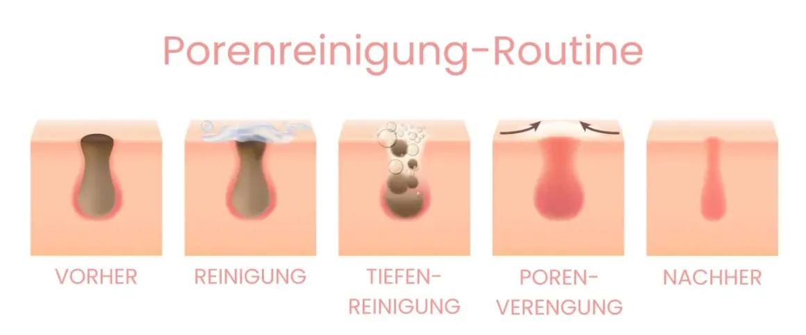 Schritt-für-Schritt-Anleitung zur Porenreinigung: Entfernen von tiefsitzenden Mitessern durch Reinigung und Verengung der Poren für reine Haut.