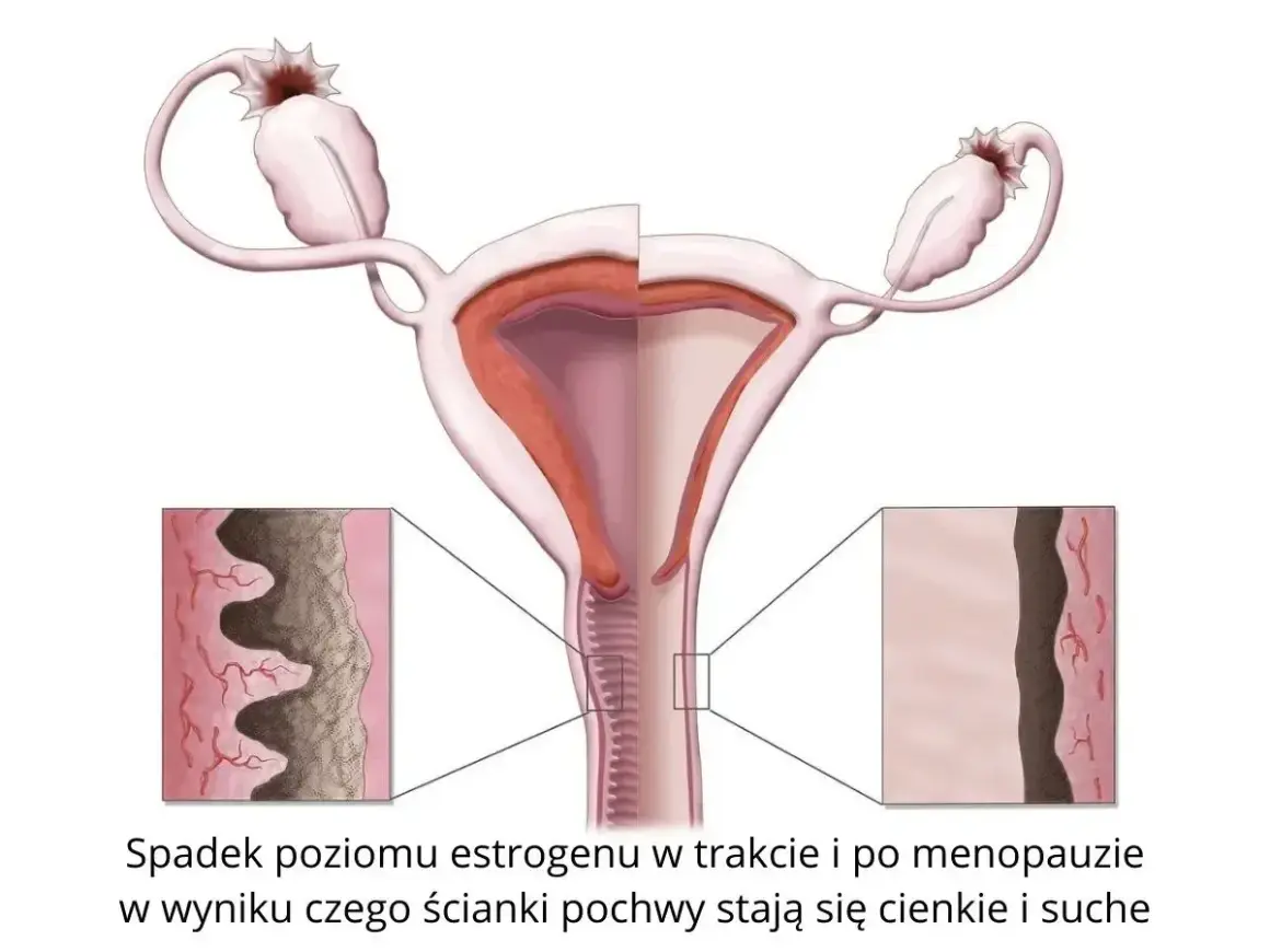 Spadek estrogenu powoduje suchość pochwy objawy: ścieńczenie i wysuszenie ścianek. Ilustracja pokazuje zmiany w narządach rodnych.