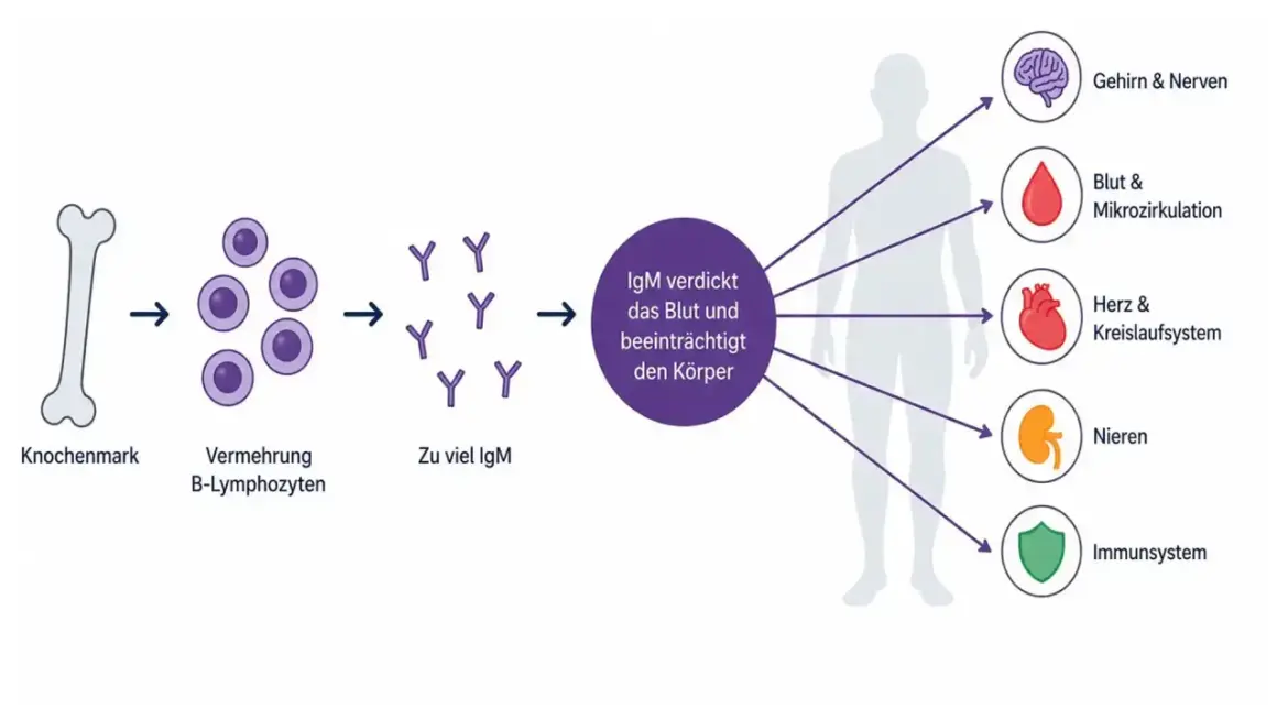 Knochenmark vermehrt B-Lymphozyten, was zu viel IgM führt. Dies verdickt das Blut und beeinträchtigt Gehirn, Herz, Nieren und Immunsystem, was auf MGUS-Beschwerden hindeutet.