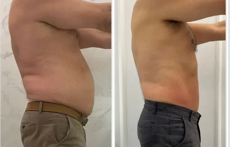 Liposukcja: Modelowanie sylwetki czy odchudzanie? Pełny przewodnik
