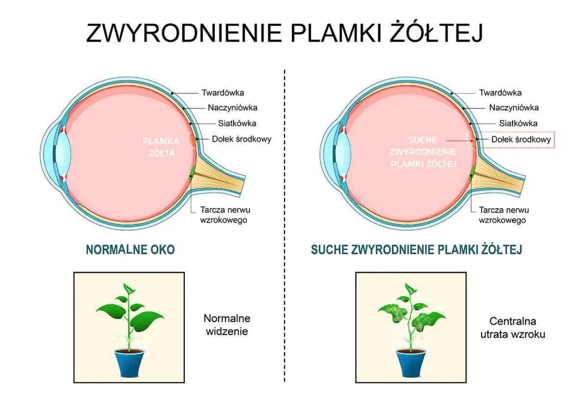 Porównanie przekroju zdrowego oka i oka z suchym zwyrodnieniem plamki żółtej.