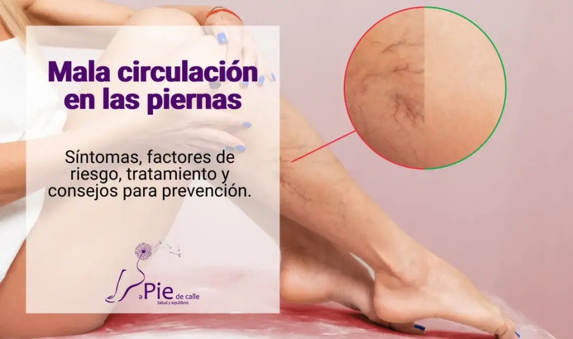 Piernas con mala circulación, mostrando arañas vasculares. Texto: "Mala circulación en las piernas. Síntomas, factores de riesgo, tratamiento y consejos para prevención.