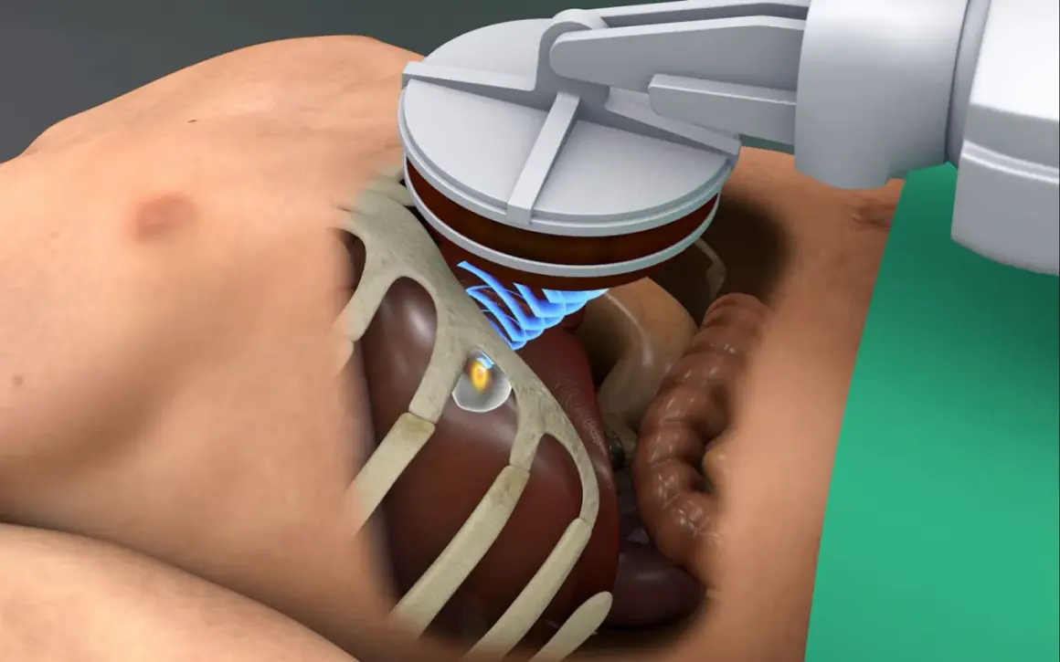 Ultraschallsonde über dem Bauchraum, ein kleiner, gelblicher tumor ultraschall erkennbar. Blaue Wellen zeigen die Schallübertragung.