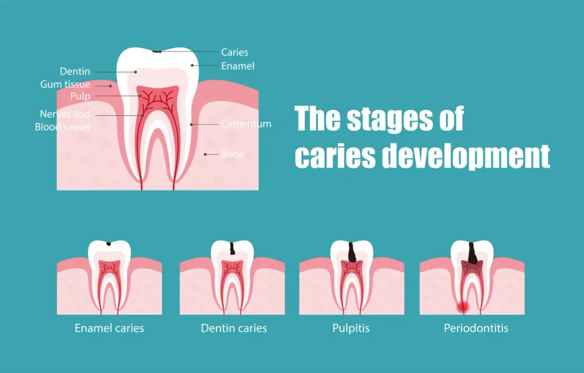 Ilustración muestra las etapas de desarrollo de una caries, desde el esmalte hasta la periodontitis, indicando cuándo empieza a doler una caries.