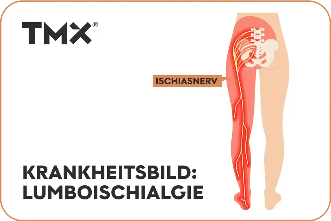 Darstellung des Ischiasnervs, der vom unteren Rücken bis zum Fuß verläuft. Das Krankheitsbild Lumboischialgie links zeigt eine Reizung dieses Nervs.