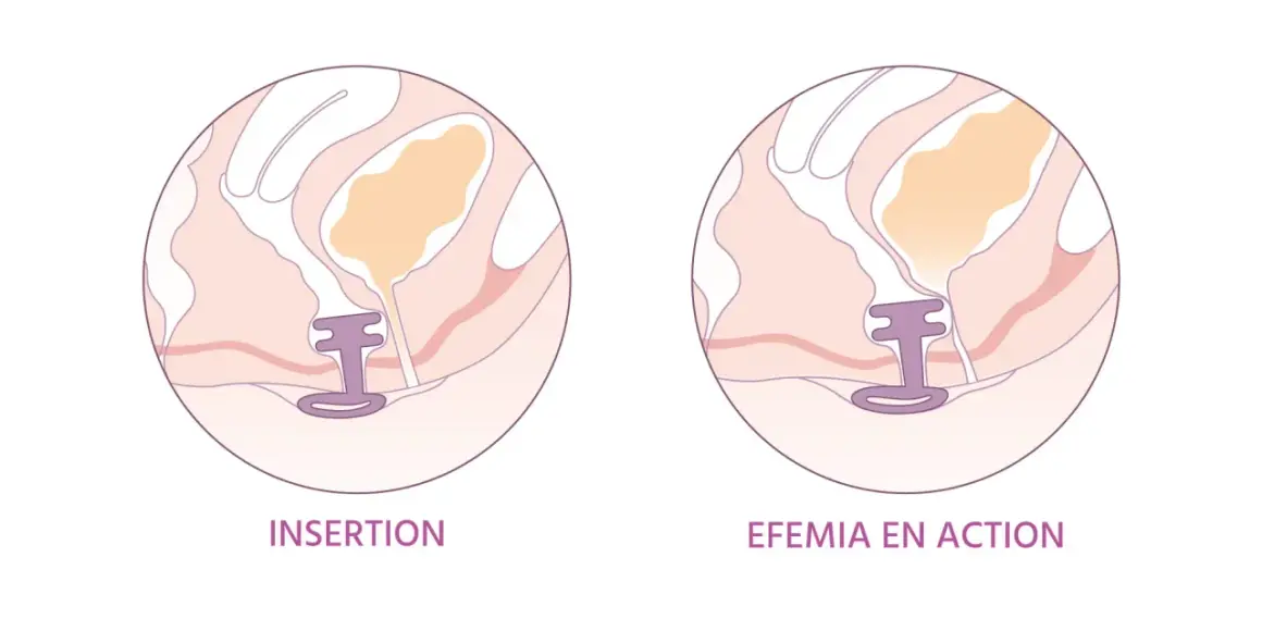 Illustration montrant l'insertion d'un dispositif pour le traitement naturel de la vessie irritée.