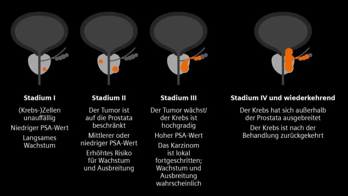 Illustrationen zeigen Stadien von Prostatakrebs, von Stadium I (unauffällig) bis Stadium IV (ausgebreitet), die die Entwicklung eines Adenokarzinoms der Prostata veranschaulichen.