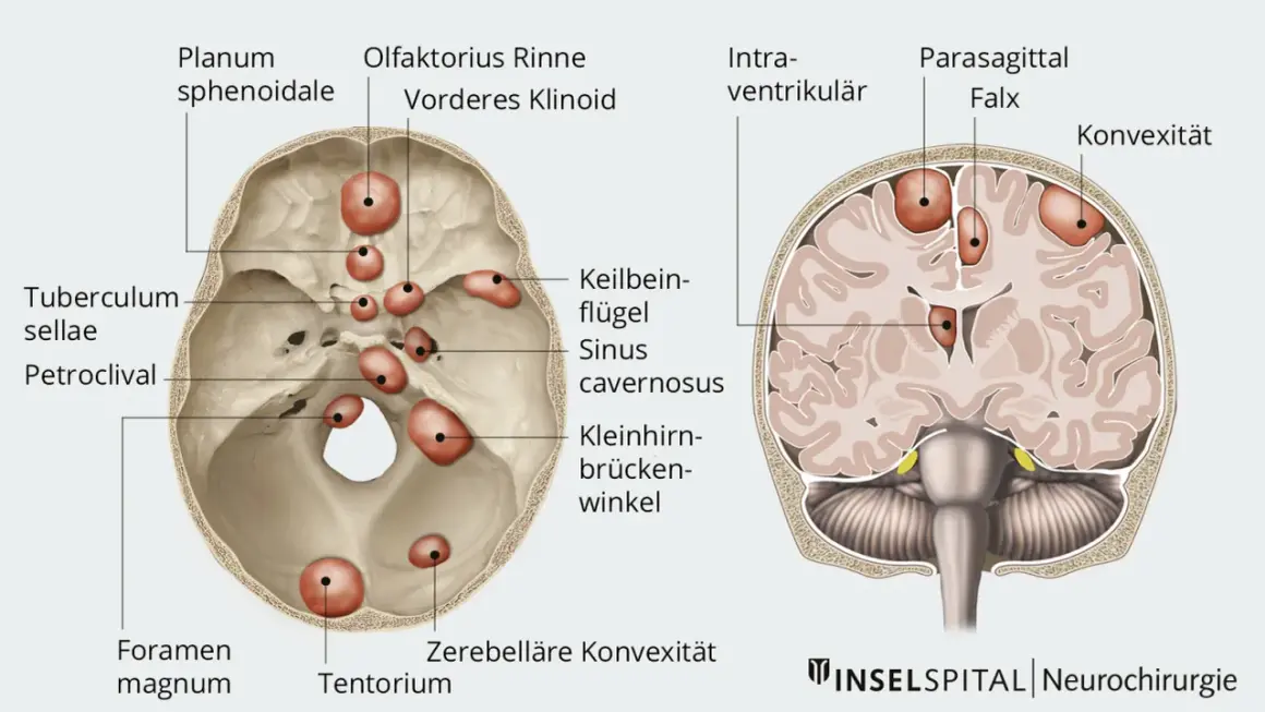 Anatomische Darstellung des Schädels mit roten Markierungen, die auf mögliche gutartige Tumoren im Kopf hindeuten. Symptome können je nach Lage variieren.