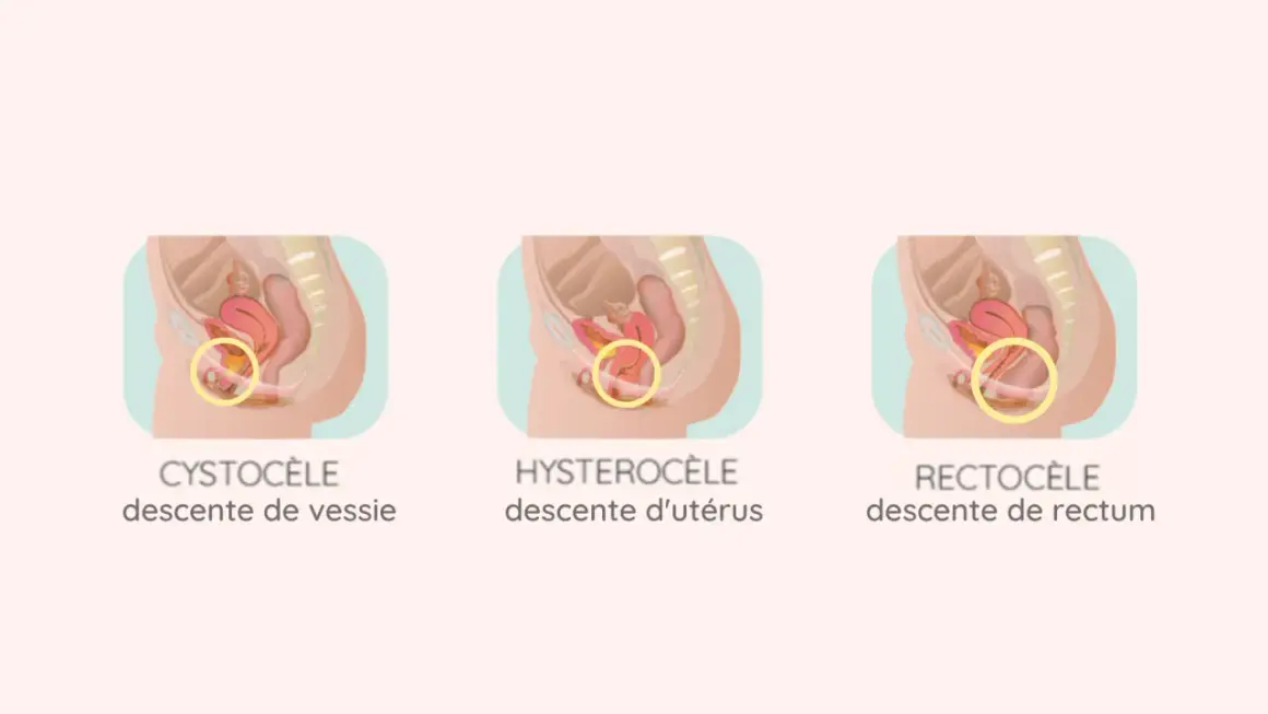 Illustration médicale montrant un prolapsus de la vessie stade 2 (cystocèle), une descente de l'utérus (hystérocèle) et une descente du rectum (rectocèle).