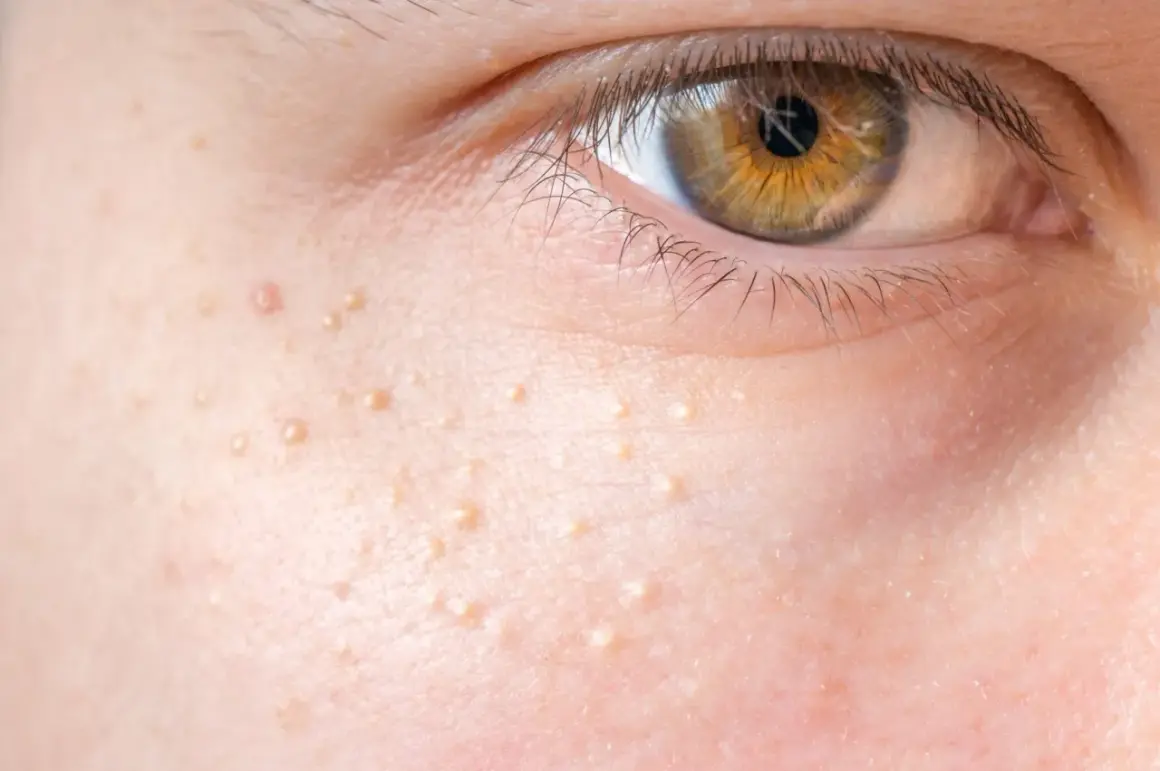Nahaufnahme der Haut neben einem Auge mit vielen kleinen, hellen Erhebungen. Diese Hautunreinheiten sind nicht komedogen und stören die natürliche Ausstrahlung nicht.