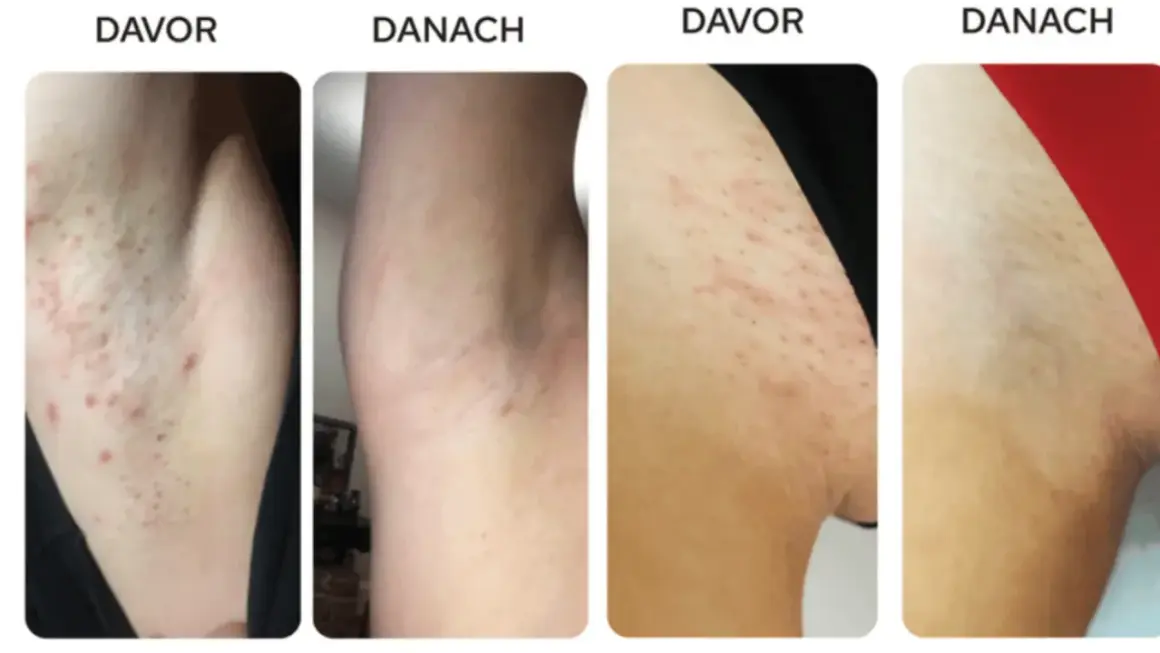 Vorher/Nachher-Bilder zeigen Achseln mit Rötungen und Pickeln nach der Rasur. Nach der Anwendung von Tipps zur Rasur sind die Achseln glatter und reizfreier.