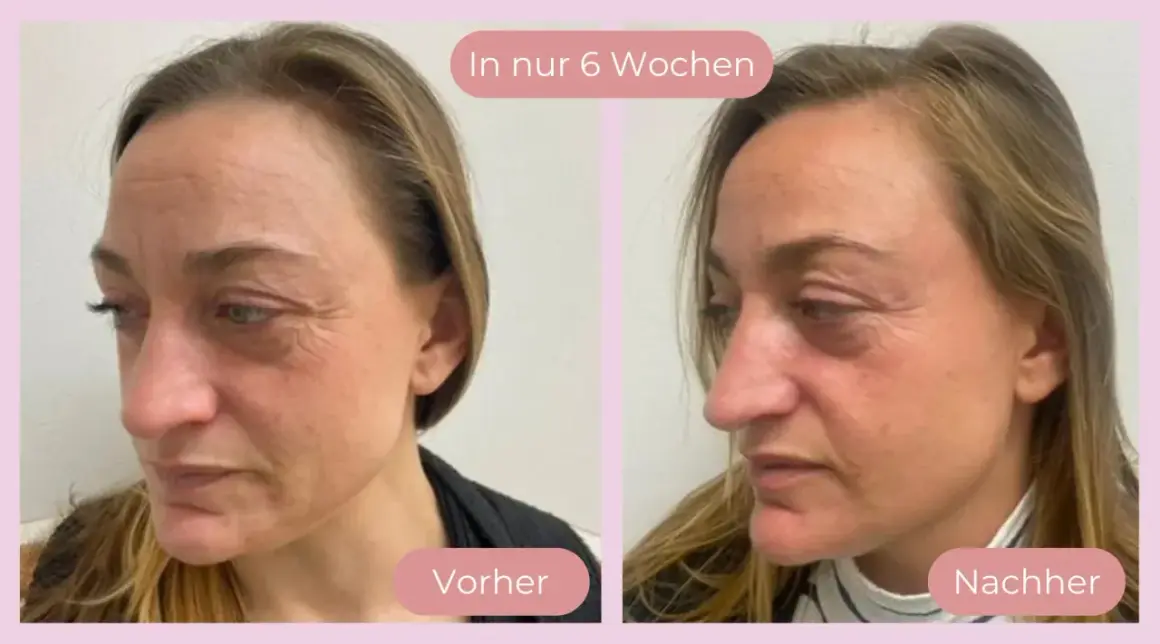 Vorher-Nachher-Vergleich: Hautbild einer Frau vor und nach 6 Wochen Behandlung. Deutliche Reduzierung von Falten, die Haut wirkt straffer. Kollagen-Effekt sichtbar.