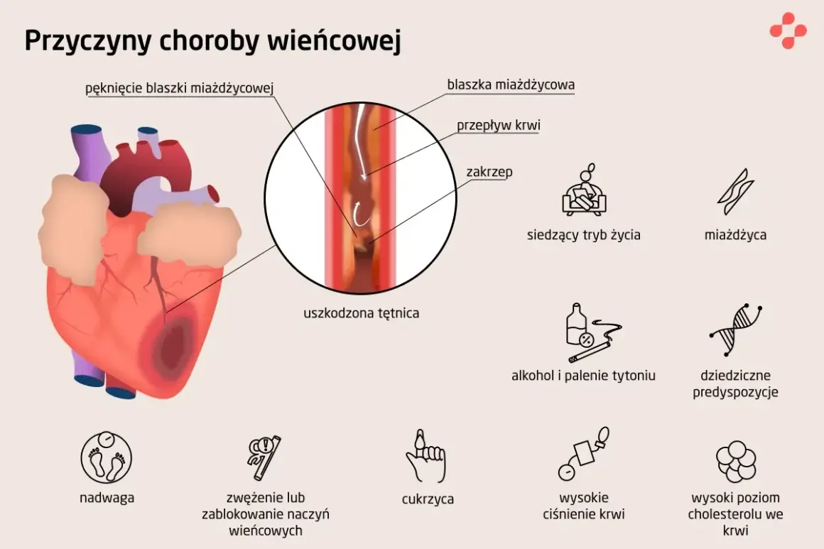 Ilustracja przedstawia serce i czynniki ryzyka choroby wieńcowej: miażdżycę, nadwagę, cukrzycę, wysokie ciśnienie, alkohol, palenie, siedzący tryb życia i predyspozycje genetyczne.