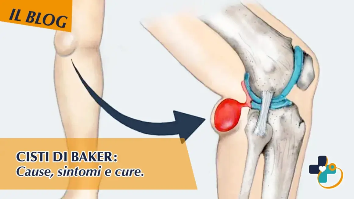 Illustrazione anatomica del ginocchio che mostra una cisti di Baker. Scopri come sfiammare cisti di Baker, cause, sintomi e cure.
