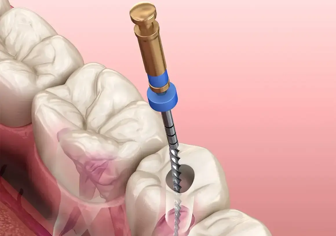 Ząb z ropą wymaga leczenia kanałowego. Narzędzie dentystyczne czyści kanał korzeniowy.
