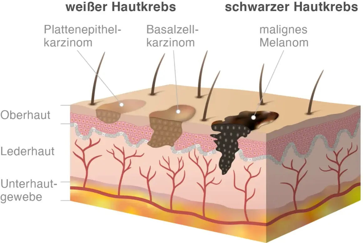 Vergleich von weißem Hautkrebs (Plattenepithelkarzinom, Basalzellkarzinom) und schwarzem Hautkrebs (malignes Melanom). Welcher Hautkrebs ist schlimmer? Das Melanom ist aggressiver.