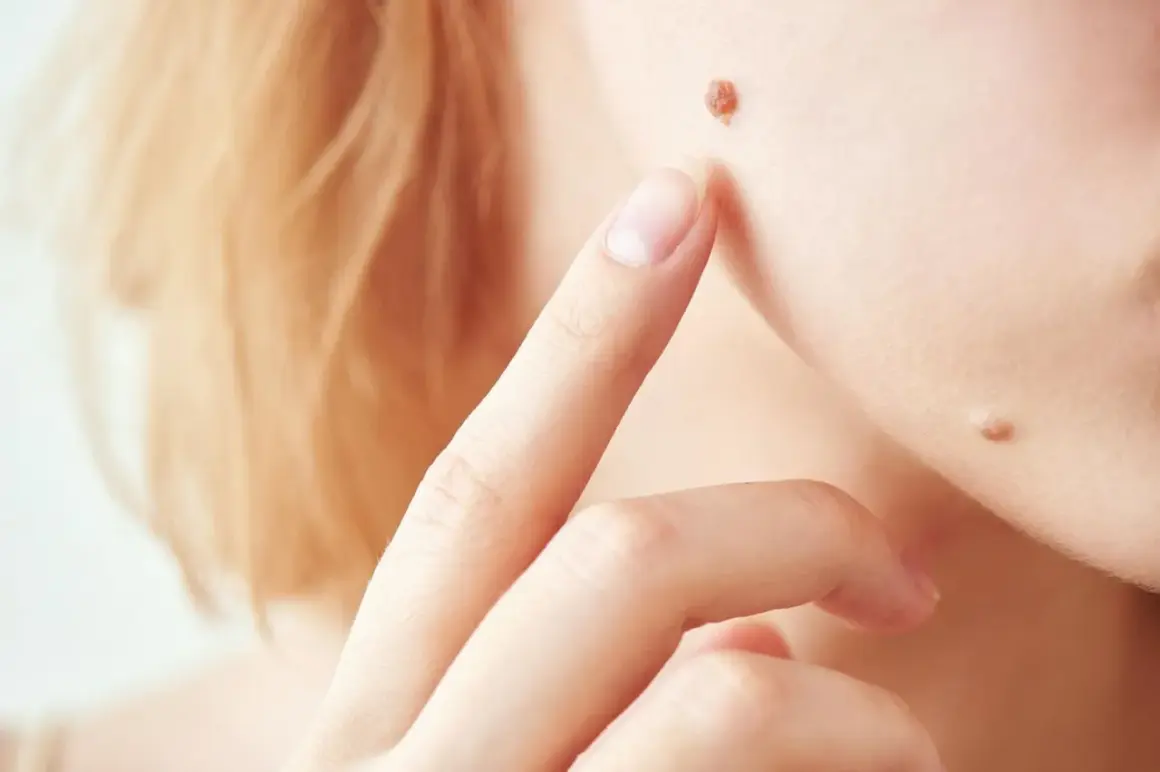 Ein Finger berührt ein Muttermal im Gesicht, das juckt. Daneben sind weitere Muttermale zu sehen.