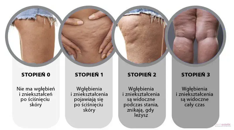 Cellulit na udach i pośladkach: skuteczne metody i zabiegi