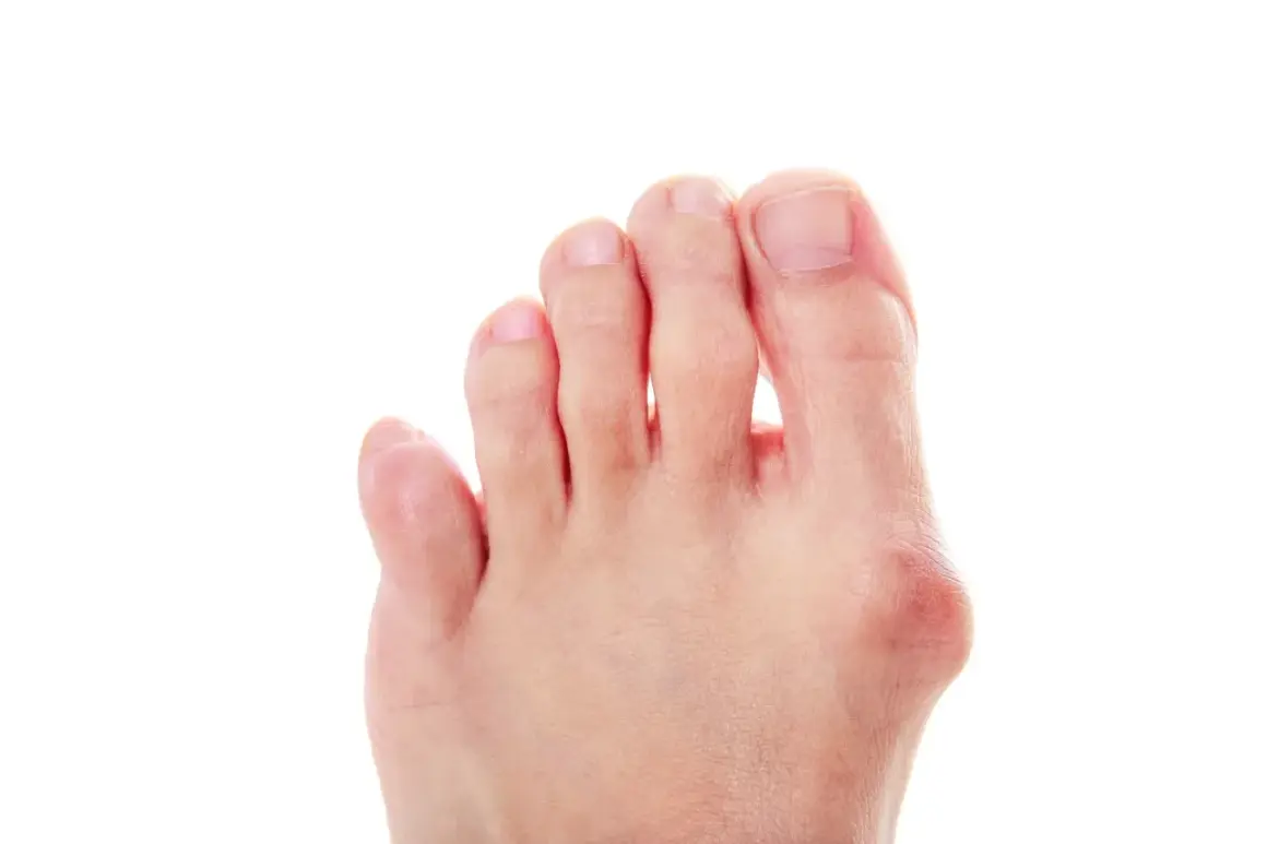 Piede con alluce valgo e dita leggermente piegate, suggerimenti su come raddrizzare le dita dei piedi.