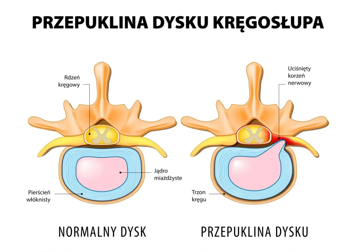 Porównanie zdrowego i przepukliny dysku kręgosłupa. Widoczny ucisk na korzeń nerwowy w przypadku przepukliny.