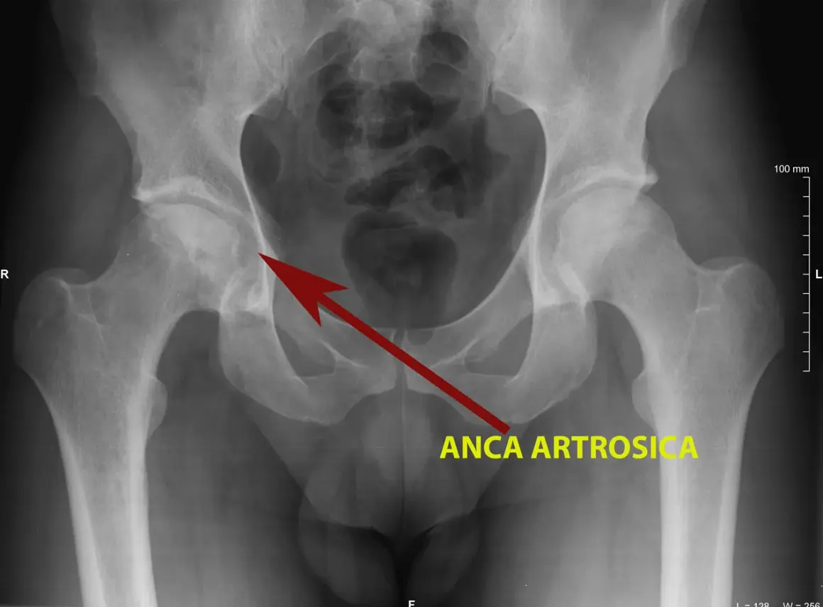 Radiografia del bacino che mostra un'anca artrosica, con il tipico "scrocchio" dovuto all'usura della cartilagine.