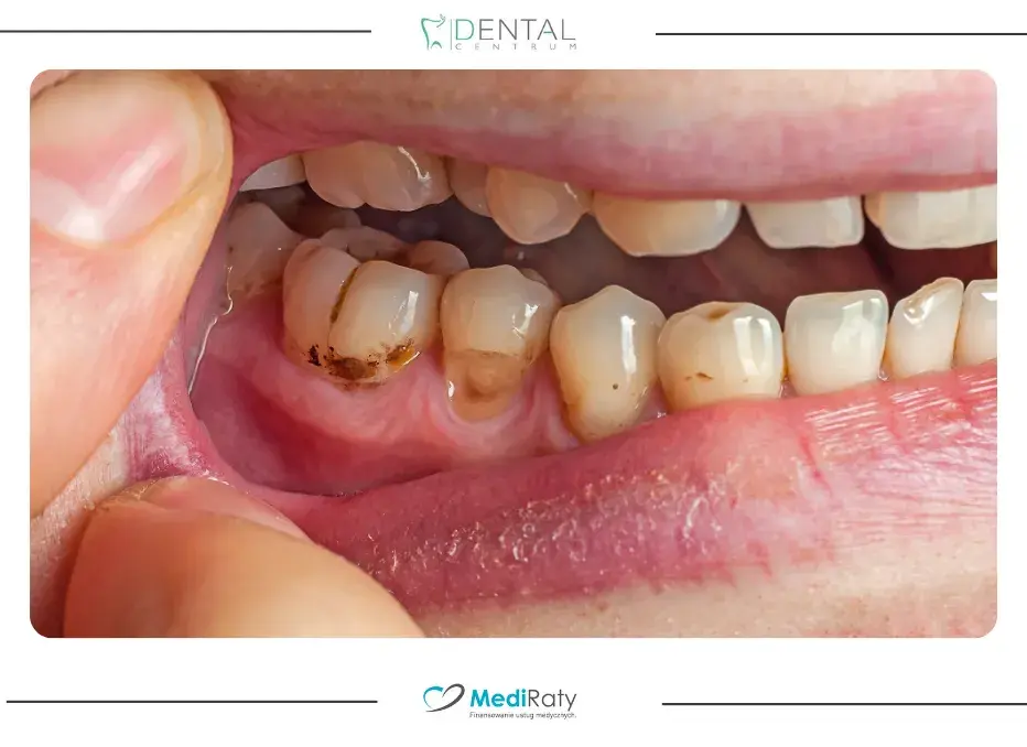 Domowe sposoby na próchnicę: Co naprawdę działa, zanim pójdziesz do dentysty?