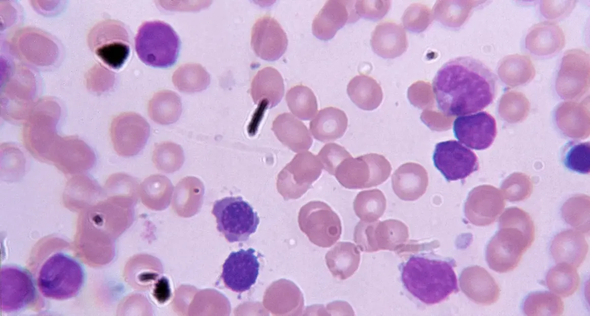Blutausstrich mit Lymphozyten und Erythrozyten. Die Anzahl der Lymphozyten kann Hinweise auf die cll lebenserwartung geben.