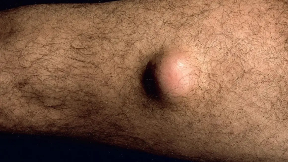 Ein gutartiger Tumor, eine helle, runde Beule, hebt sich auf der behaarten Haut eines Arms ab.