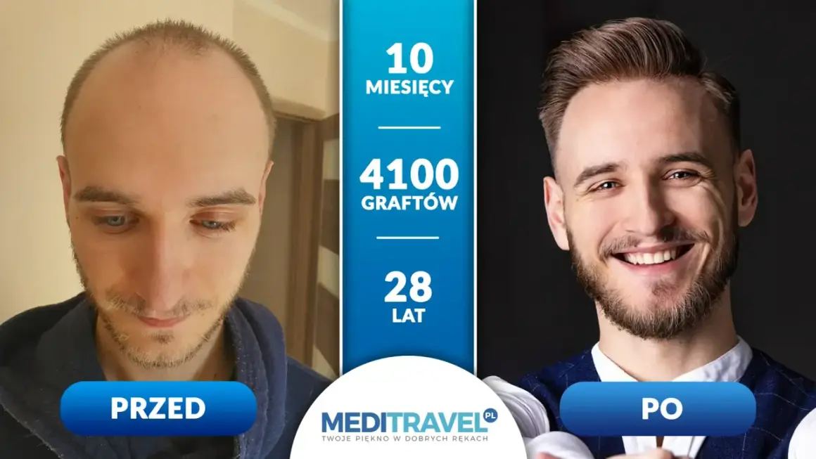 Przed i po przeszczepie włosów: 10 miesięcy, 4100 graftów, 28 lat. Zastanawiasz się, ile kosztuje przeszczep włosów?