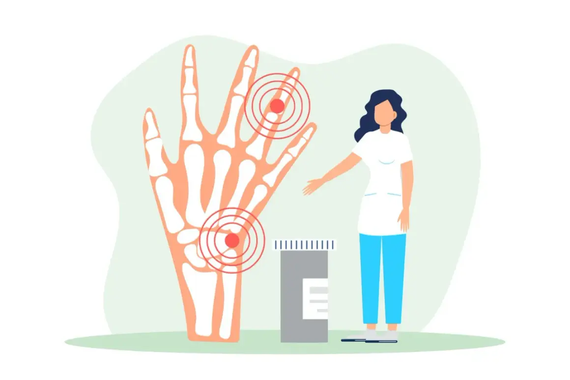 Illustrazione di una mano con ossa evidenziate e cerchi rossi che indicano dolore alle dita delle mani quando stringo. Vicino, una dottoressa e un flacone di pillole.