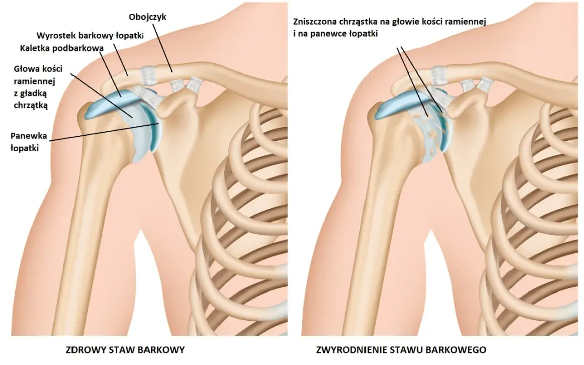 Zdrowy staw barkowy z gładką chrzątką na głowie kości ramiennej i panewce łopatki obok stawu ze zniszczoną chrząstką.
