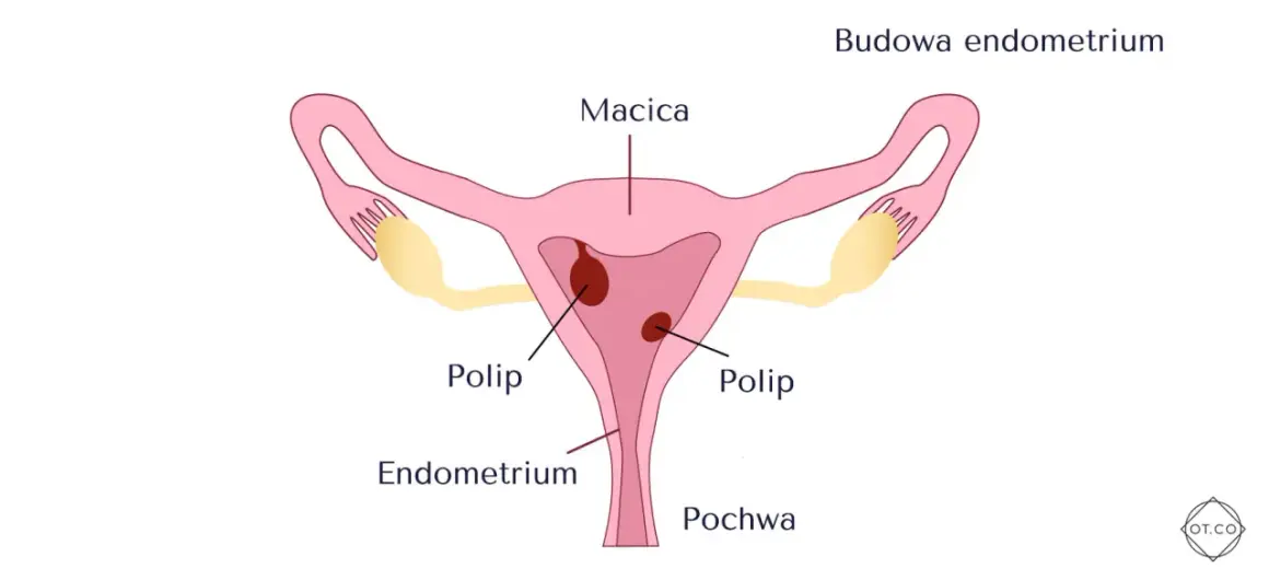 Schemat budowy macicy z widocznymi polipami w obrębie endometrium.