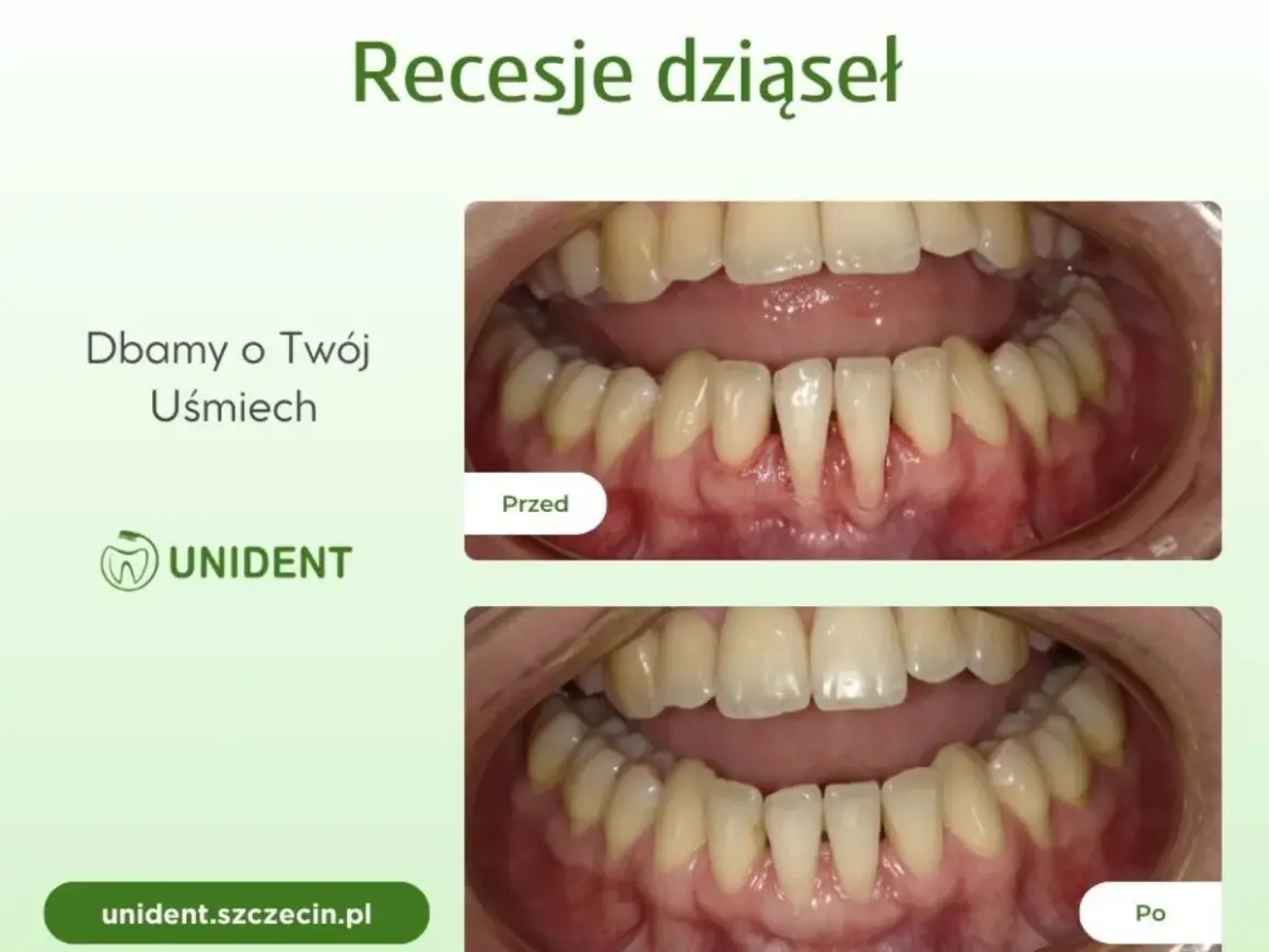 Przed i po leczeniu recesji dziąseł. Widoczne poprawa stanu dziąseł po zabiegu.