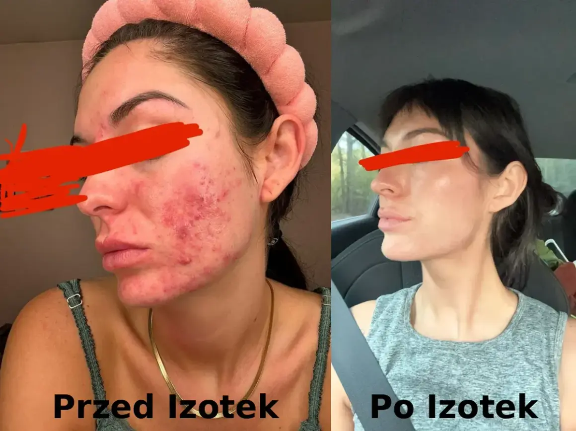 Przed i po leczeniu izotekiem: skóra z trądzikiem i zaczerwienieniem przechodzi transformację w gładką i czystą cerę.