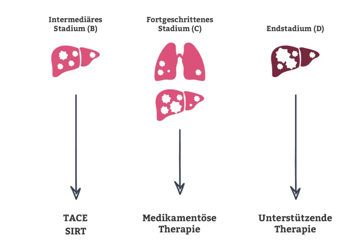 Illustration zeigt Stadien von Leberkrebs (B, C, D) mit Lungenmetastasen. Leberkrebs blutwerte sind wichtig für die Therapieentscheidung.