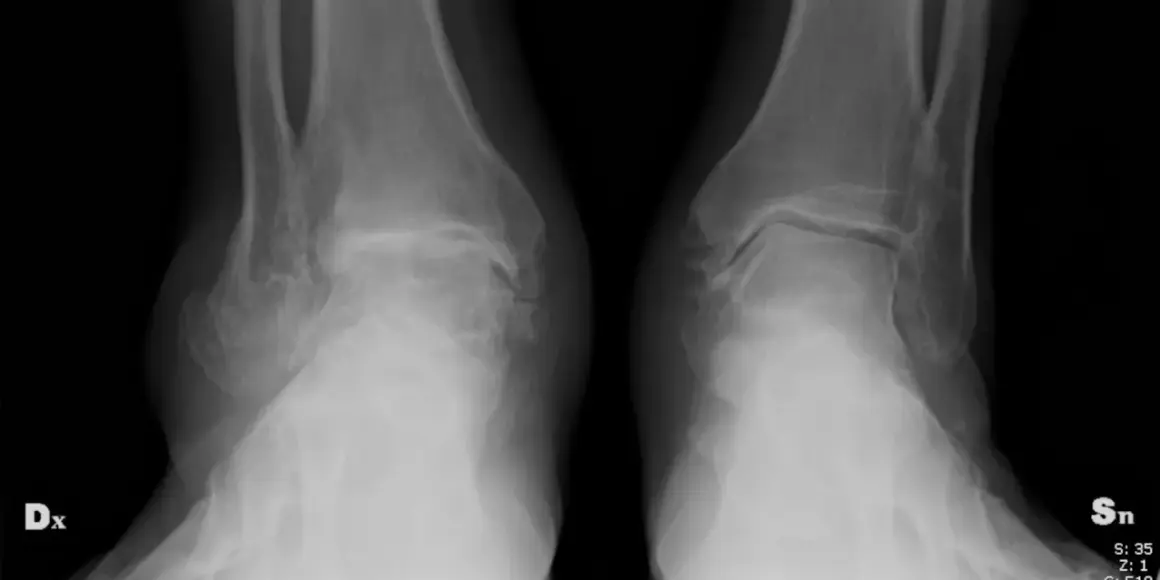 Radiografie delle caviglie mostrano segni di condropatia, con alterazioni articolari evidenti.
