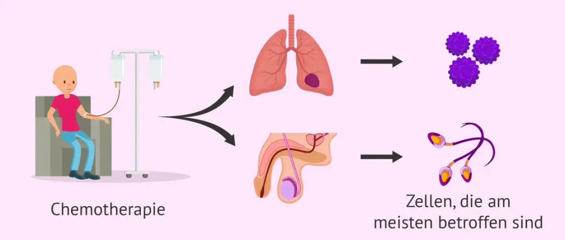 Chemotherapie kann die Fruchtbarkeit nach Chemotherapie Mann beeinträchtigen. Die Grafik zeigt Lungen- und Hodenkrebszellen, die durch die Behandlung angegriffen werden.