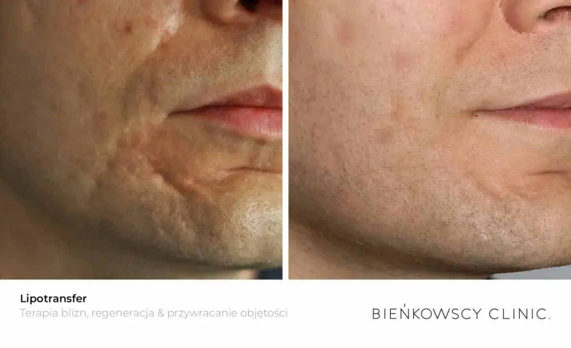 Przed i po lipofilling twarzy: widoczna poprawa blizn i przywrócenie objętości skóry.