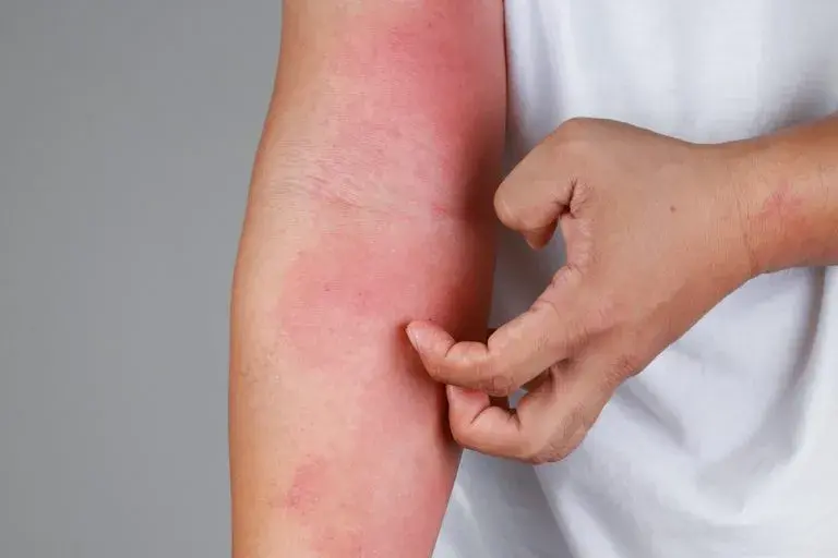Nietolerancja fruktozy objawy skórne - rzadkie symptomy, które zaskakują