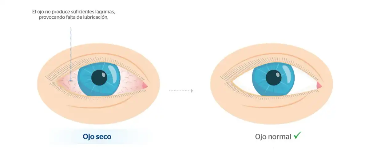 Ojos hinchados al despertar - causas, remedios y señales de alerta