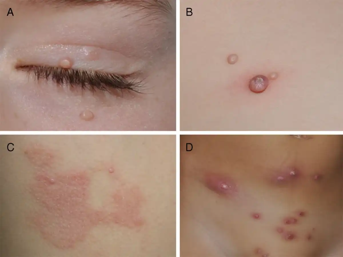 Molusco contagioso en niños y adolescentes - guía práctica