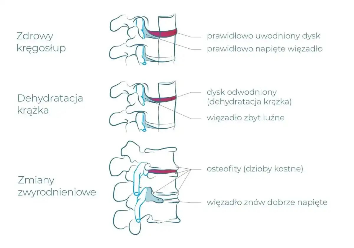 Zwyrodnienie kręgosłupa lędźwiowego - kiedy badać i jak leczyć?