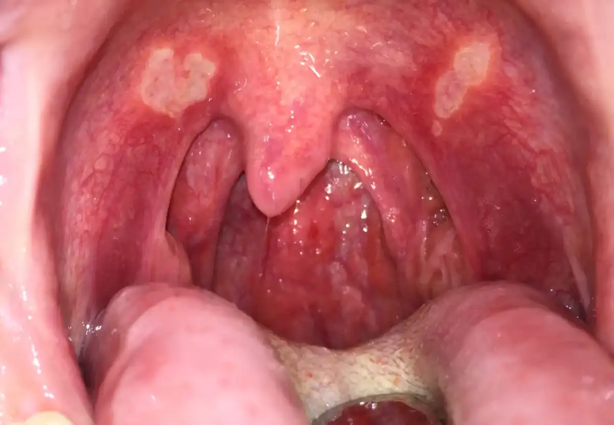 Afta al palato - come distinguerla da herpes e candidosi