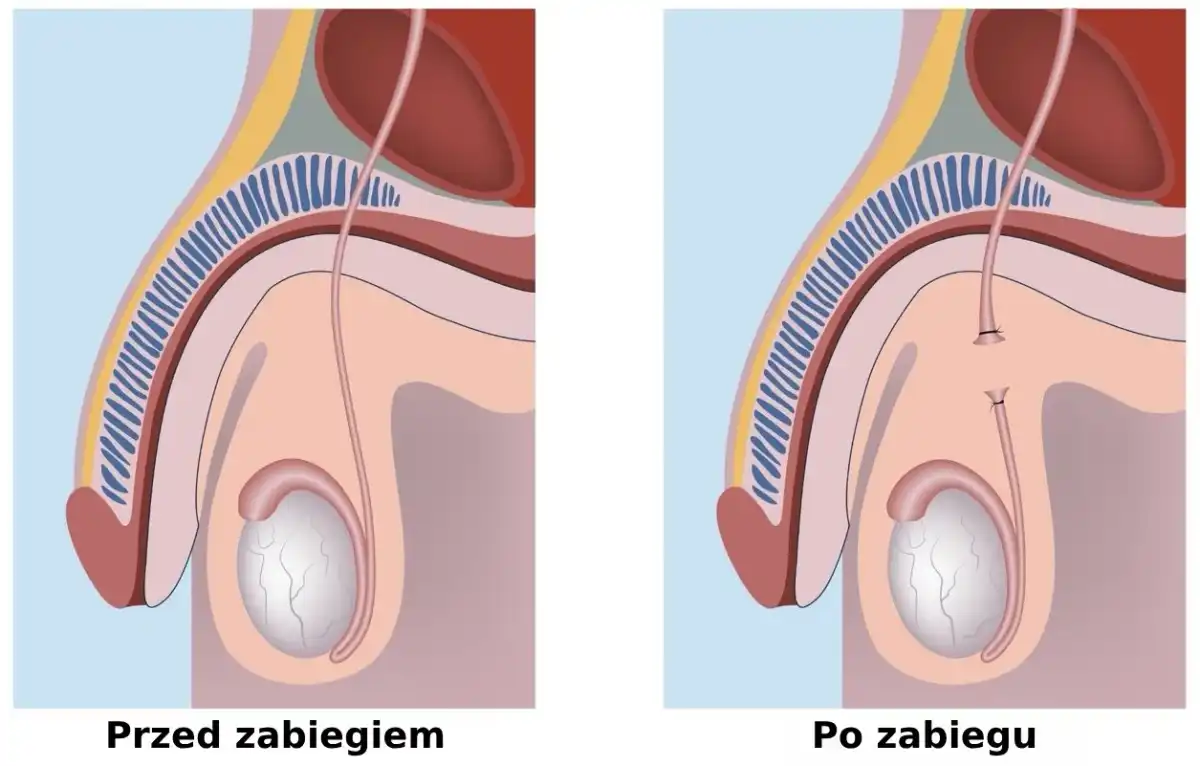 Wazektomia odwracalna? Szanse na ciążę i realia zabiegu