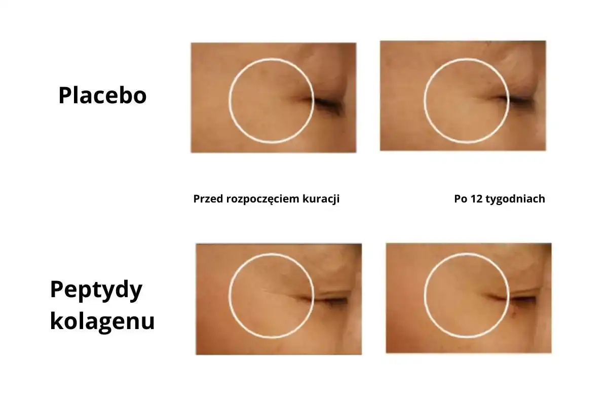 Kolagen po suplementacji - kiedy szkodzi, a kiedy to choroba?