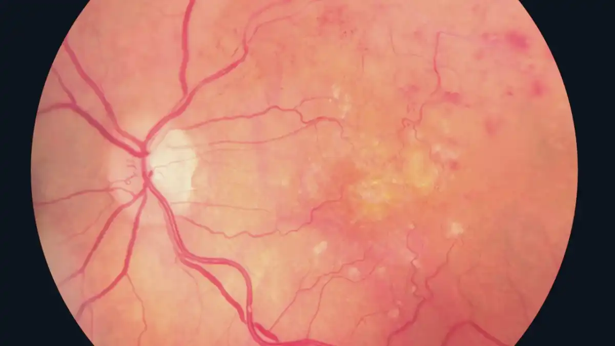 Retinopatia cukrzycowa - kiedy reagować, by chronić wzrok?