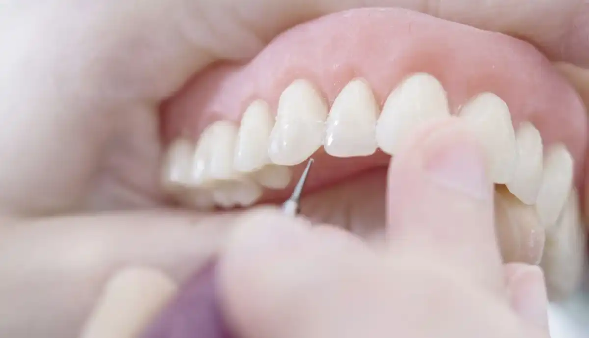 Come abituarsi alla dentiera e gestire dolore e irritazioni