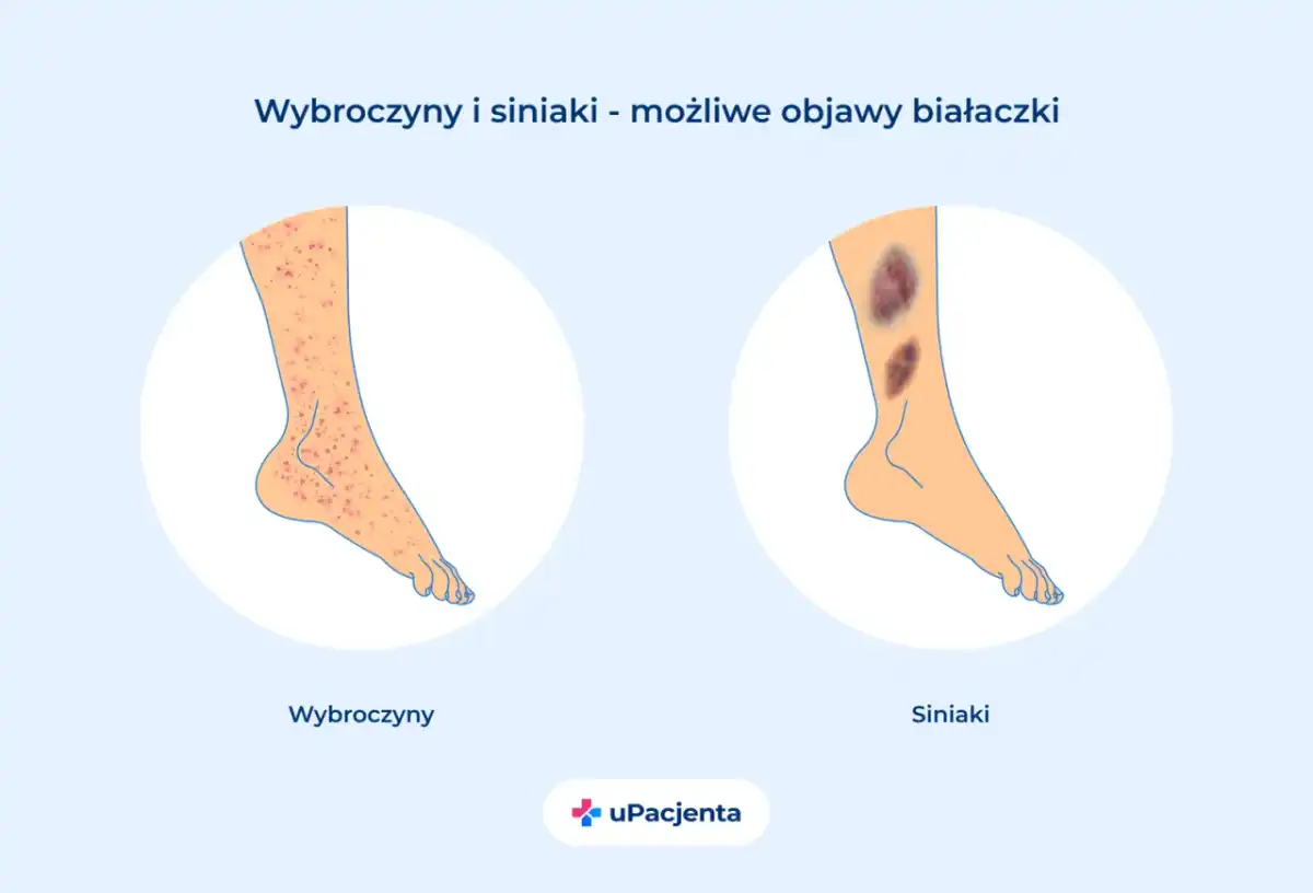 Objawy białaczki - Czy to tylko zmęczenie? Sprawdź!
