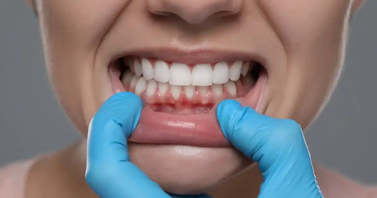 Ból od odsłoniętych szyjek? Co działa w domu i kiedy do dentysty